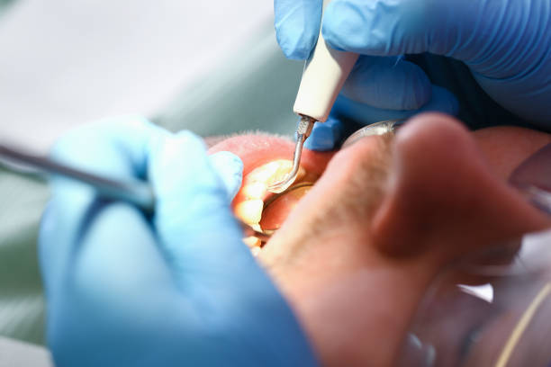 Best Emergency Treatment for Dental Infections or Abscesses in Delhi, CA